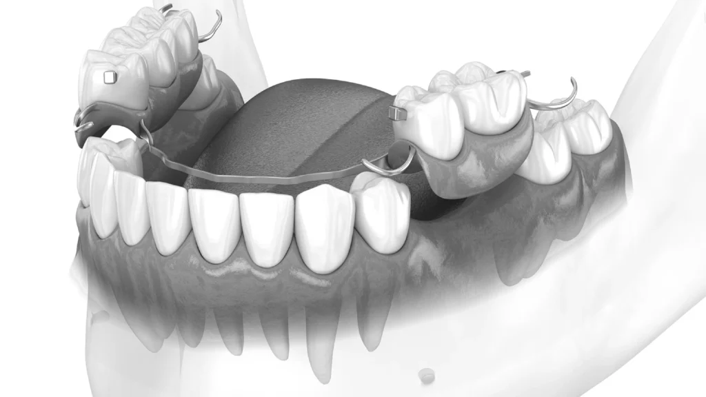 Can you keep partial dentures in all the time?